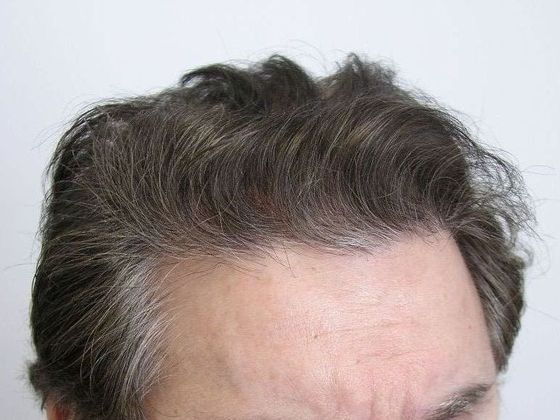Male Before And After Hair Transplant Photos Front & Top (4) - After