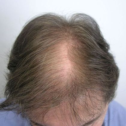 Hair Transplant - Male: Front & Top - Case 49 - Before FUT hair transplant