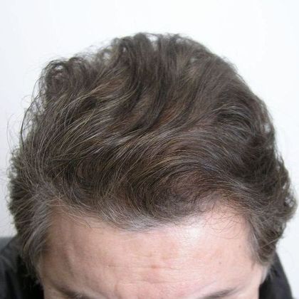 Hair Transplant - Male: Front & Top - Case 49 - After FUT hair transplant