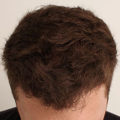 Male Before And After Hair Transplant Photos Frontal FUT (2) - After