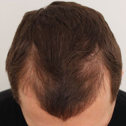 Male Before And After Hair Transplant Photos Frontal FUT (2) - Before