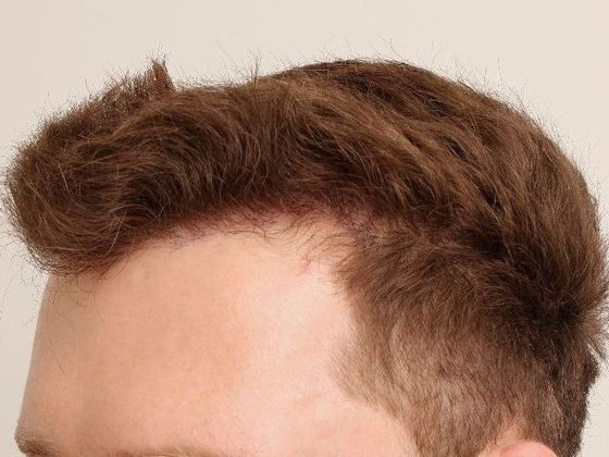 Hair Transplant - Male: Frontal FUT - Case 41 - After FUT hair transplant