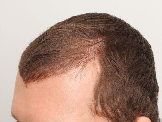 Hair Transplant - Male: Frontal FUT - Case 41 - Before FUT hair transplant