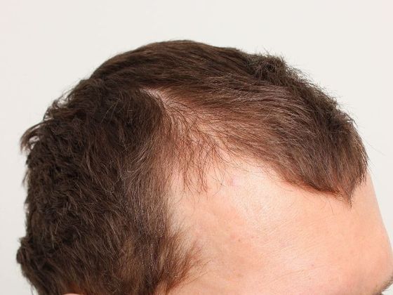 Hair Transplant - Male: Frontal FUT - Case 41 - Before FUT hair transplant