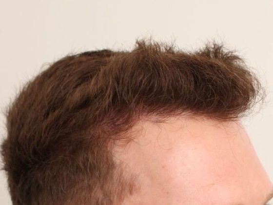 Hair Transplant - Male: Frontal FUT - Case 41 - After FUT hair transplant