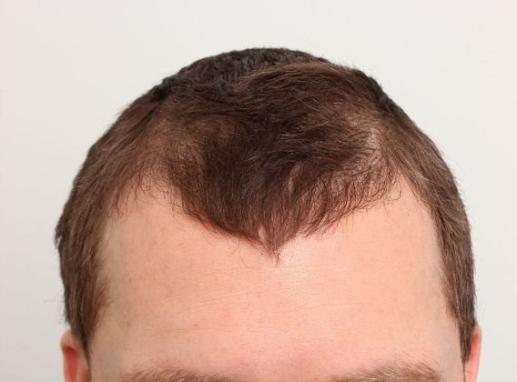Hair Transplant - Male: Frontal FUT - Case 41 - Before FUT hair transplant