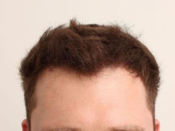 Hair Transplant - Male: Frontal FUT - Case 41 - After FUT hair transplant