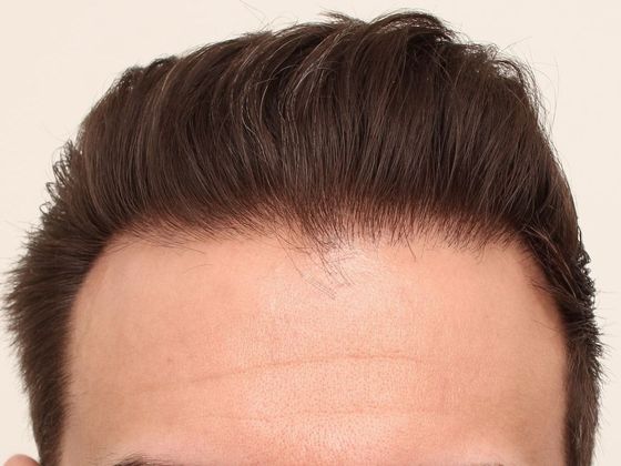 Hair Transplant - Male: Hairline FUE - Case 20 - After FUE hair transplant