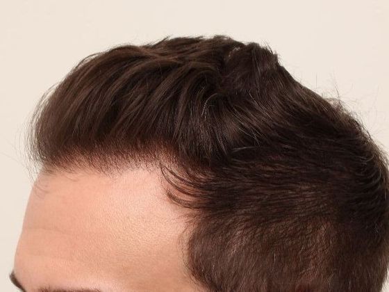 Hair Transplant - Male: Hairline FUE - Case 20 - After FUE hair transplant