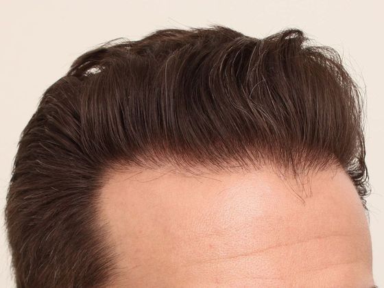 Male Before And After Hair Transplant Photos Hairline FUE (20) - After
