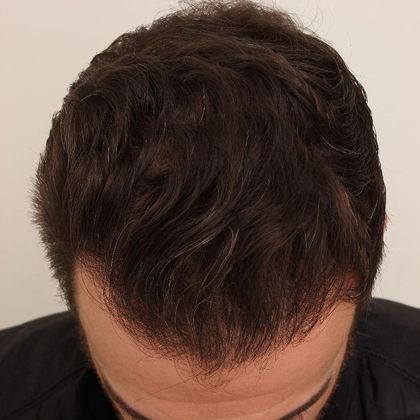 Hair Transplant - Male: Hairline FUE - Case 20 - After FUE hair transplant