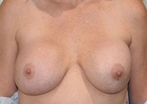 Breast Revision: Case 153 - Before