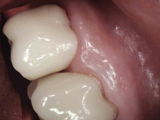 Same Day Service With Ceramic Restorations Case 2 - After