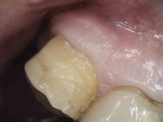 Same Day Service With Ceramic Restorations Case 2 - Before