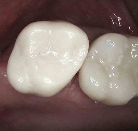 Same Day Service With Ceramic Restorations: Case 2 - After