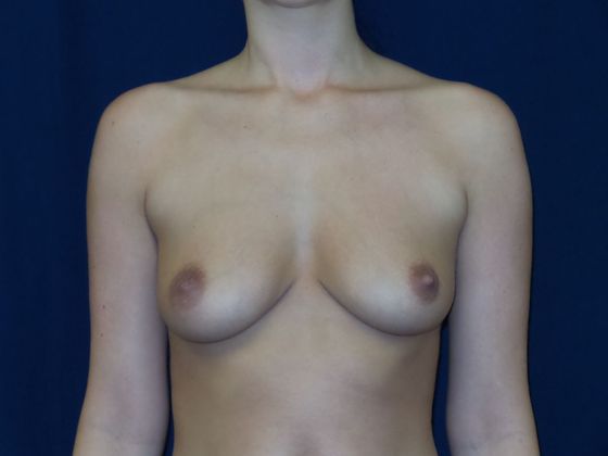 Breast Augmentation*: Case 58 - Before