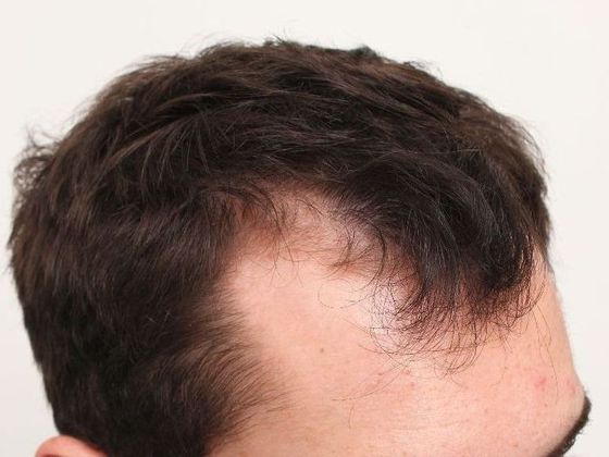 Hair Transplant - Male: Hairline FUT - Case 35 - Before FUT hair transplant