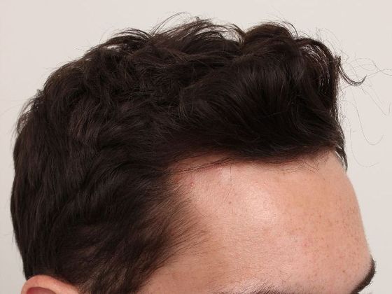 Hair Transplant - Male: Hairline FUT - Case 35 - After FUT hair transplant