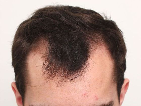 Male Before And After Hair Transplant Photos Hairline FUT (3) - Before