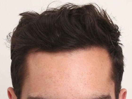 Male Before And After Hair Transplant Photos Hairline FUT (3) - After