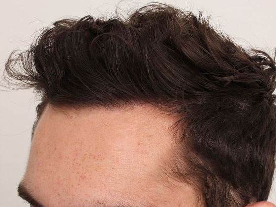 Hair Transplant - Male: Hairline FUT - Case 35 - After FUT hair transplant