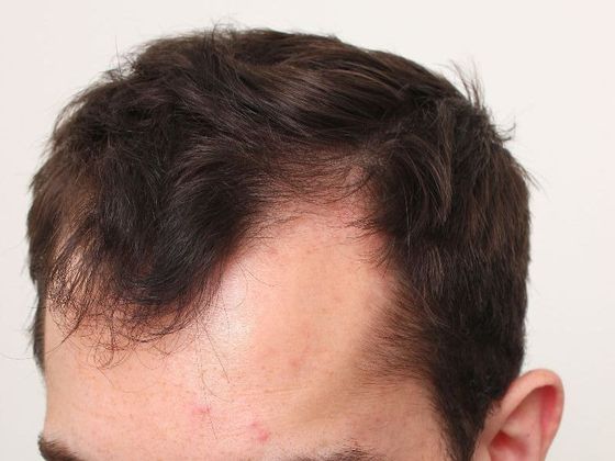 Hair Transplant - Male: Hairline FUT - Case 35 - Before