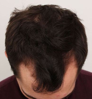 Hair Transplant - Male: Hairline FUT - Case 35 - Before FUT hair transplant