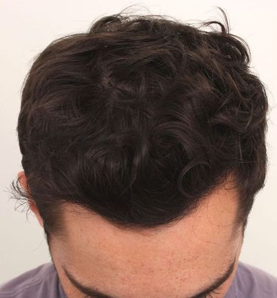 Hair Transplant - Male: Hairline FUT - Case 35 - After FUT hair transplant