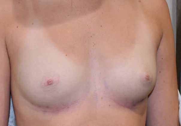 Breast Augmentation: Case 609 - Before