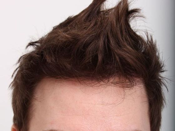 Male Before And After Hair Transplant Photos Frontal FUT (5) - After
