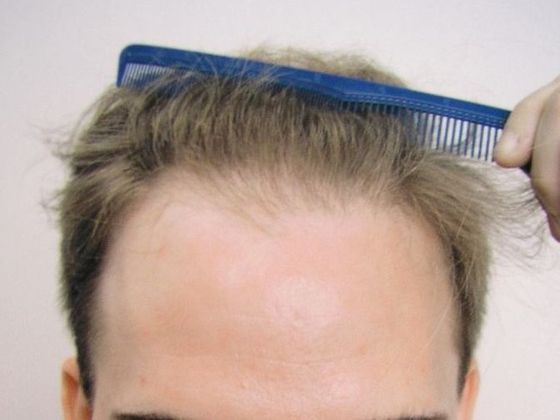 Male Before And After Hair Transplant Photos Frontal FUT (5) - Before