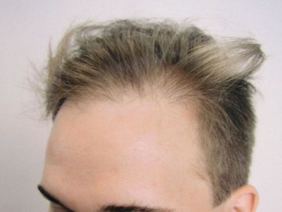Hair Transplant - Male: Frontal FUT - Case 44 - Before FUT hair transplant
