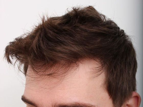 Hair Transplant - Male: Frontal FUT - Case 44 - After FUT hair transplant