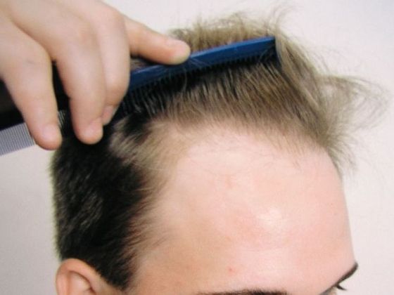 Hair Transplant - Male: Frontal FUT - Case 44 - Before FUT hair transplant