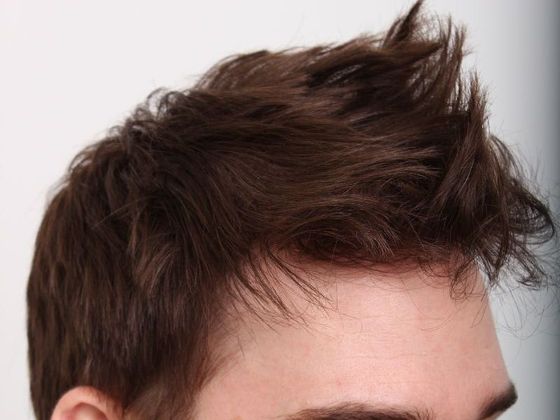 Hair Transplant - Male: Frontal FUT - Case 44 - After FUT hair transplant