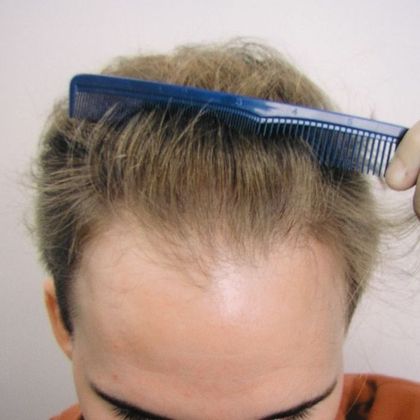 Hair Transplant - Male: Frontal FUT - Case 44 - Before FUT hair transplant