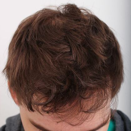 Hair Transplant - Male: Frontal FUT - Case 44 - After FUT hair transplant