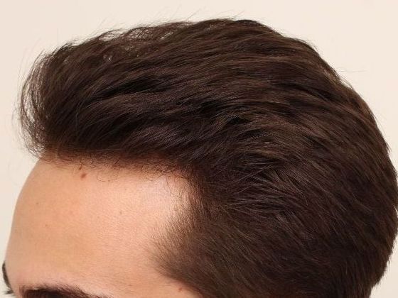 Male Before And After Hair Transplant Photos Hairline FUE (7) - After