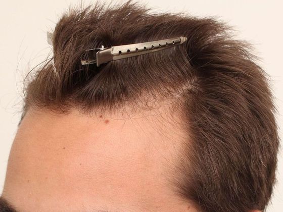 Male Before And After Hair Transplant Photos Hairline FUE (7) - Before