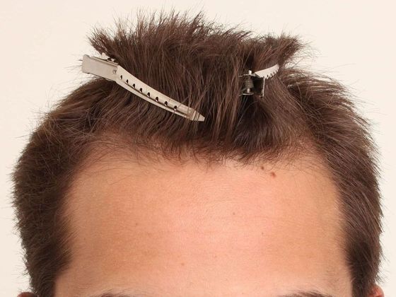 Hair Transplant - Male: Hairline FUE - Case 7 - Before FUE hair transplant