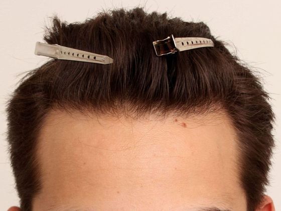 Hair Transplant - Male: Hairline FUE - Case 7 - After FUE hair transplant