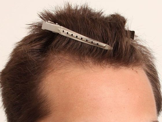 Hair Transplant - Male: Hairline FUE - Case 7 - Before FUE hair transplant