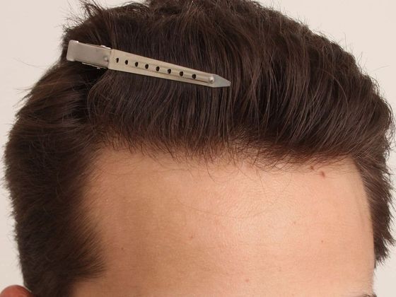 Hair Transplant - Male: Hairline FUE - Case 7 - After FUE hair transplant