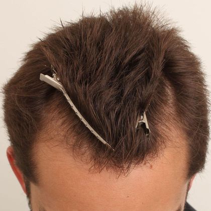 Hair Transplant - Male: Hairline FUE - Case 7 - Before FUE hair transplant