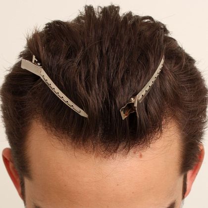 Hair Transplant - Male: Hairline FUE - Case 7 - After FUE hair transplant