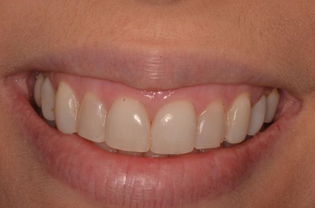 Gum Lift or Crown lengthening Case 3 - Before