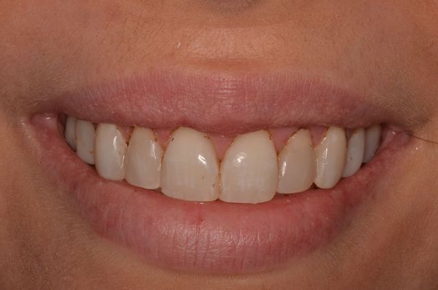 Gum Lift or Crown lengthening Case 3 - After