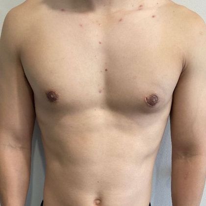 Male Breast Reduction Case 5 Gynecomastia, Minimally invasive, Norwalk, CT - After