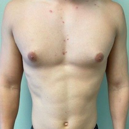 Male Breast Reduction Case 5 Gynecomastia, Minimally invasive, Norwalk, CT - Before