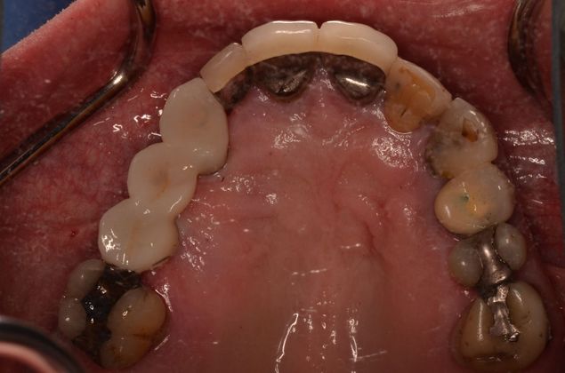 Bridges Case 6 - After